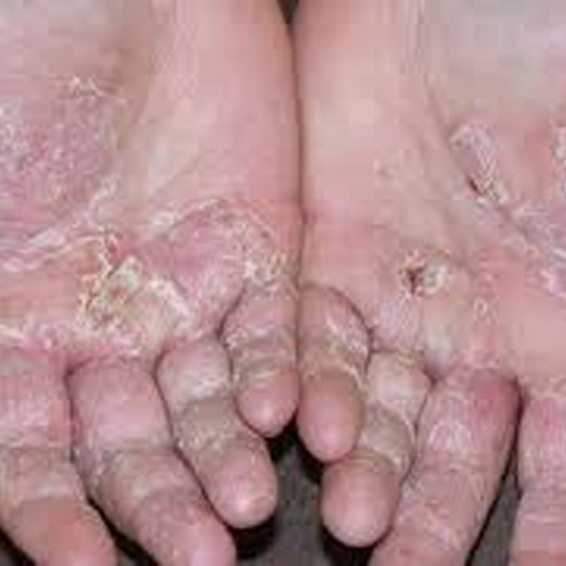 hand dermatitis